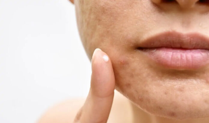pelle acne